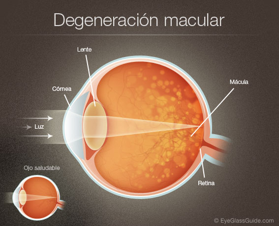 Los signos tempranos de la degeneración macular relacionada con la edad son más frecuentes en los enfermos de Alzheimer.